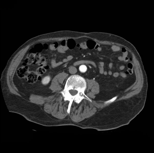 File:Aortic dissection with rupture into pericardium (Radiopaedia 12384-12647 A 68).jpg