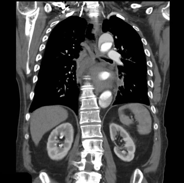 File:Aortic dissection with rupture into pericardium (Radiopaedia 12384-12647 B 29).jpg