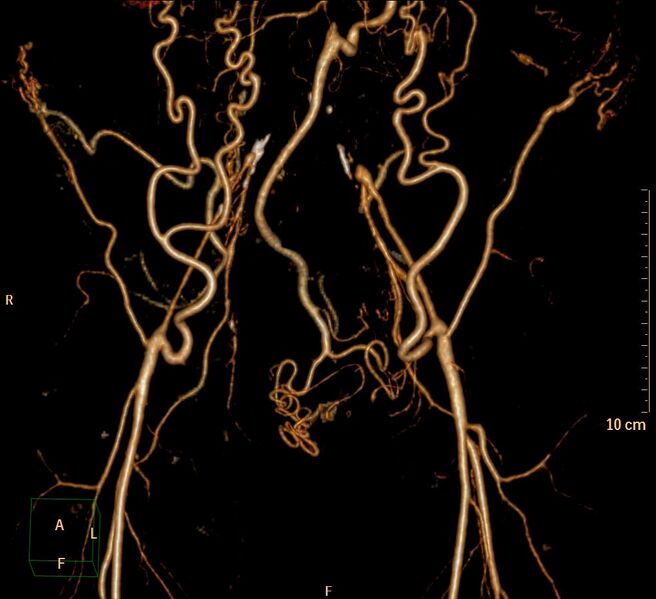 File:Aortoiliac occlusive disease (Radiopaedia 31376-32161 3D-VR-iliac arteries 2).jpg
