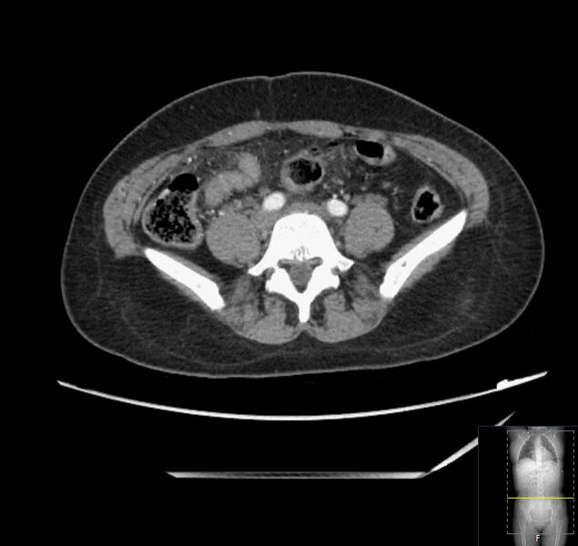 File:Appendicitis (CT angiogram) (Radiopaedia 154713-127660 Axial 31).jpg