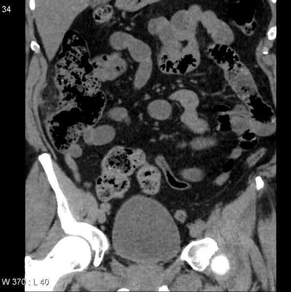File:Appendicitis (Radiopaedia 12510-12733 Coronal non-contrast 4).jpg
