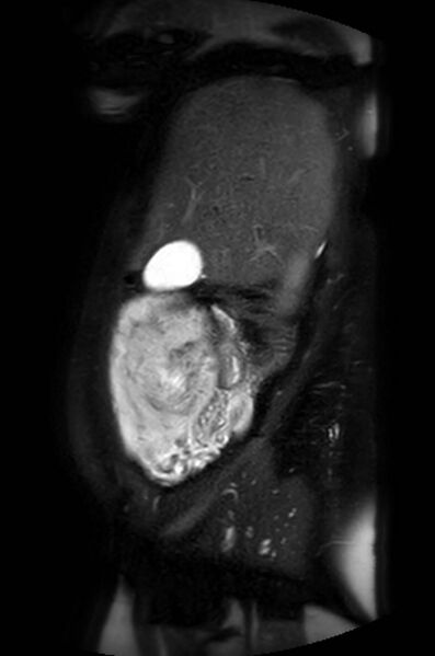 File:Appendicitis in gravida (MRI) (Radiopaedia 89433-106395 Sagittal T2 SPAIR 51).jpg