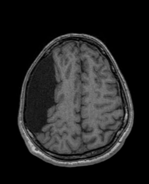 File:Arachnoid cyst- extremely large (Radiopaedia 68741-78451 Axial T1 60).jpg