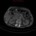 Arachnoiditis ossificans (Radiopaedia 51394-57136 Axial bone window 12).jpg