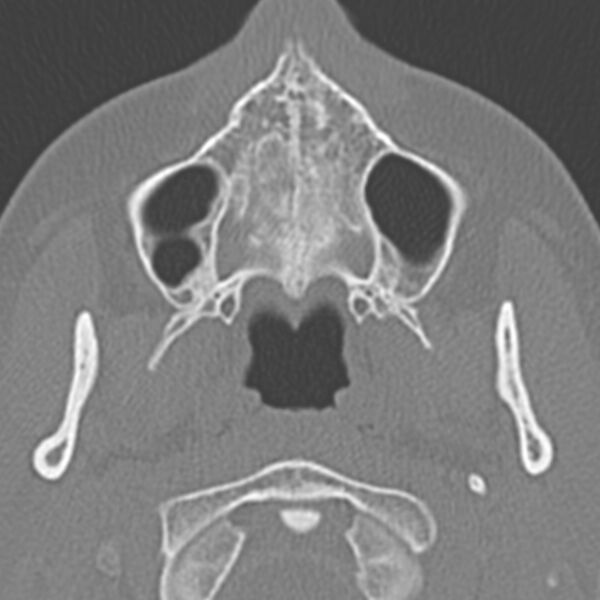 File:Arrested pneumatization of the sphenoid (Radiopaedia 10700-11172 Axial non-contrast 20).jpg