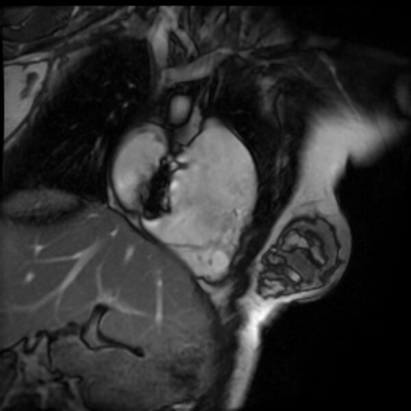 File:Arrhythmogenic right ventricular cardiomyopathy (Radiopaedia 87505-103850 2ch (RV) Cine SSFP 84).jpg