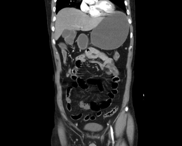 File:Arterial occlusive mesenteric ischemia (Radiopaedia 84641-100060 B 17).jpg