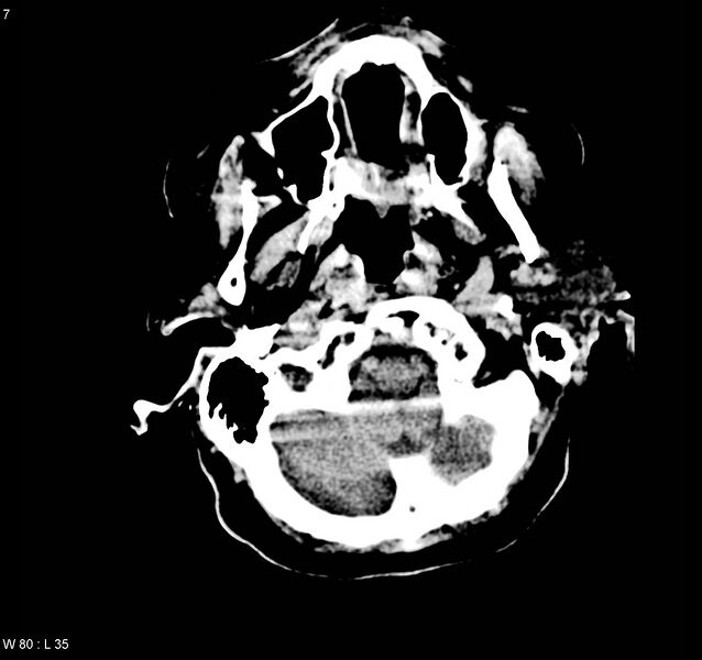 File:Arteriovenous malformation - cerebral (Radiopaedia 8172-9020 Axial non-contrast 1).jpg