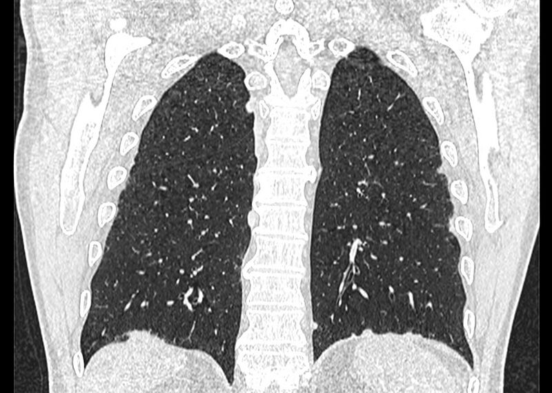 File:Asbestos pleural placques (Radiopaedia 57905-64872 Coronal lung window 226).jpg