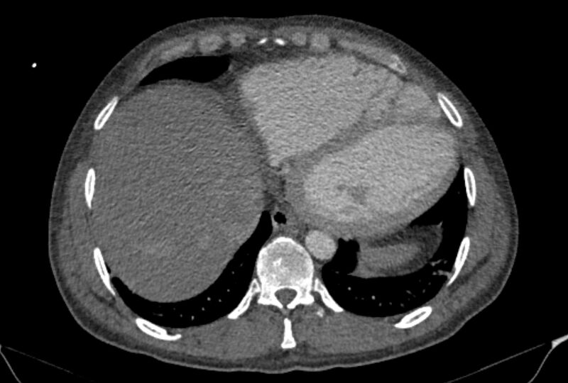 File:Ascending aortic aneurysm (Radiopaedia 86279-102297 C 53).jpg