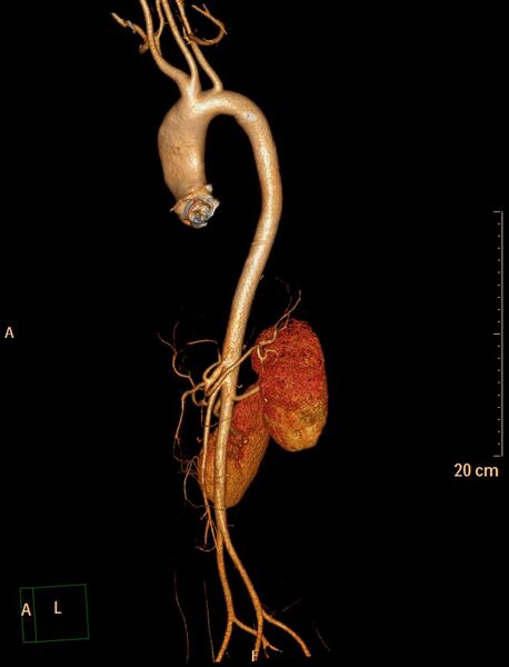 File:Ascending aortic pseudoaneurysm (Radiopaedia 28638-28910 D 27).jpg