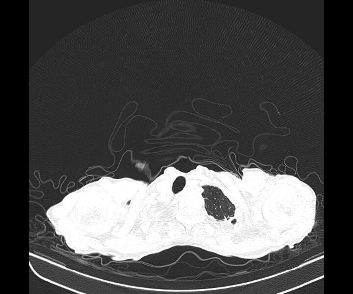 File:Aspergillomas (Radiopaedia 66779-76110 Axial lung window 9).jpg