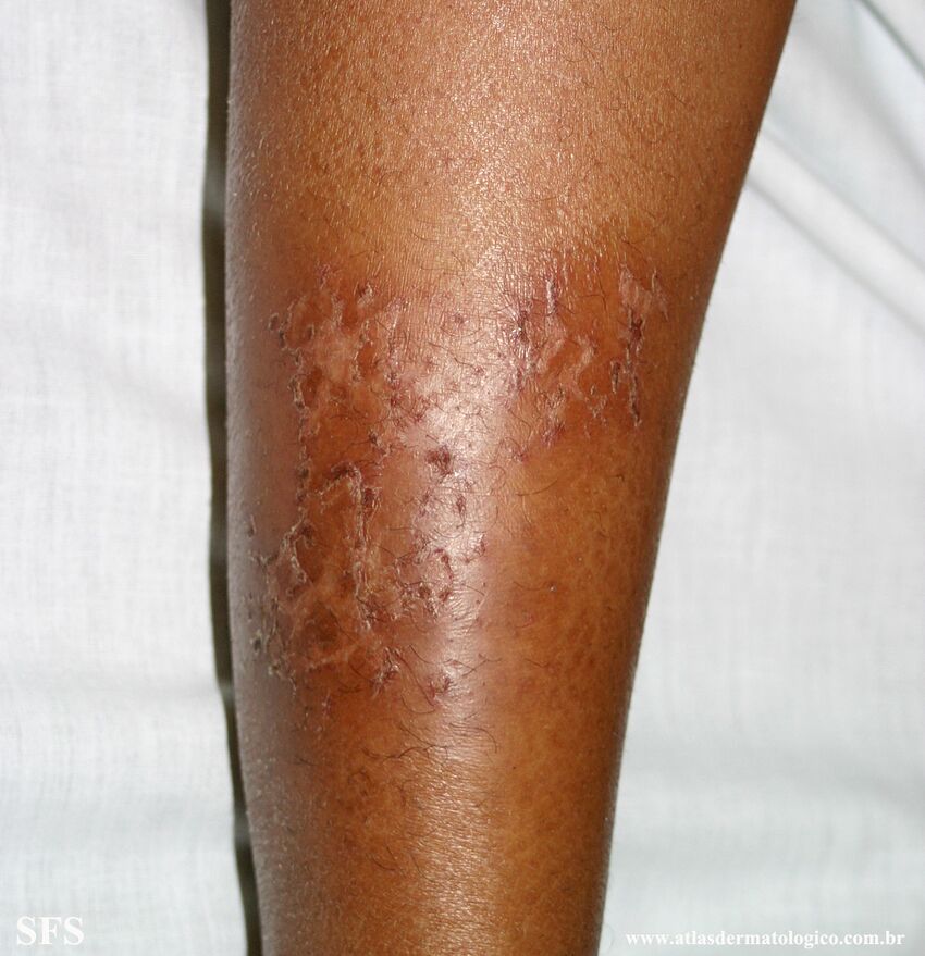 Asteatotic Dermatitis (Dermatology Atlas 11).jpg