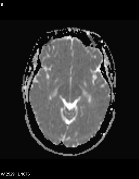 File:Astroblastoma (Radiopaedia 39792-42217 Axial ADC 8).jpg