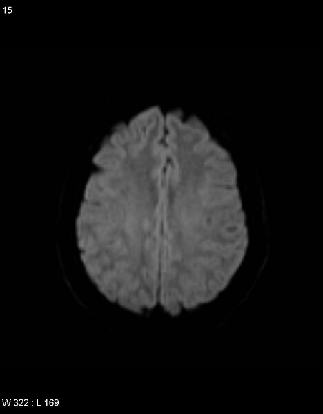 File:Astroblastoma (Radiopaedia 39792-42217 Axial DWI 14).jpg