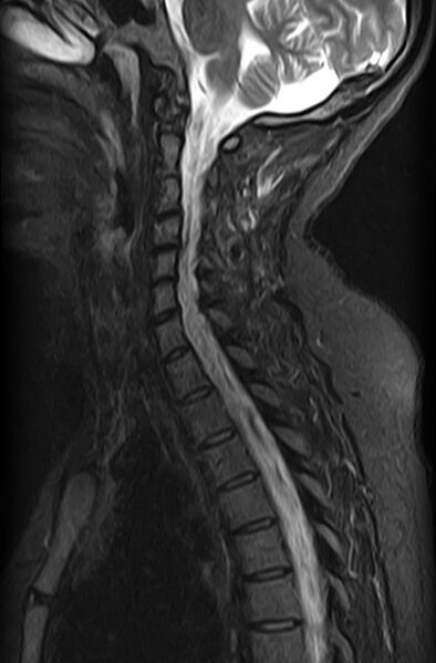 File:Astrocytoma - spinal cord (Radiopaedia 69769-79758 Sagittal STIR 8).jpg