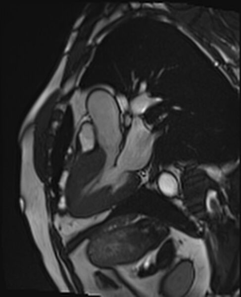 File:Asymmetric septal hypertrophic cardiomyopathy - systolic anterior motion of mitral leaflet (Radiopaedia 72795-83445 B 17).jpg
