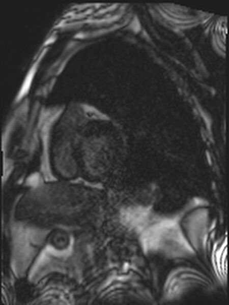 File:Asymmetric septal hypertrophic cardiomyopathy - systolic anterior motion of mitral leaflet (Radiopaedia 72795-83445 E 4).jpg