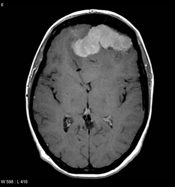 File:Atypical meningioma (WHO grade II) (Radiopaedia 7762-8586 D 2).jpg