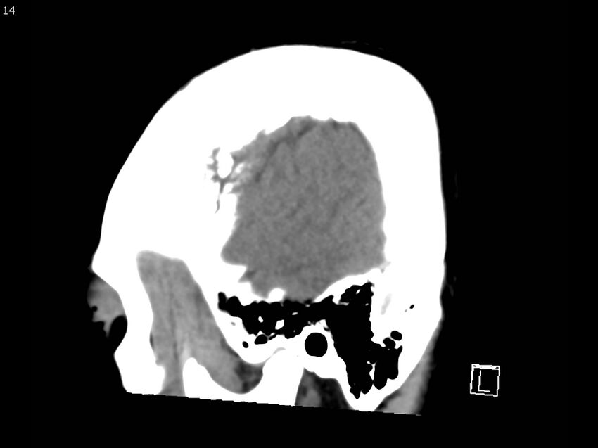 Atypical meningioma - intraosseous (Radiopaedia 64915-73867 C 12).jpg