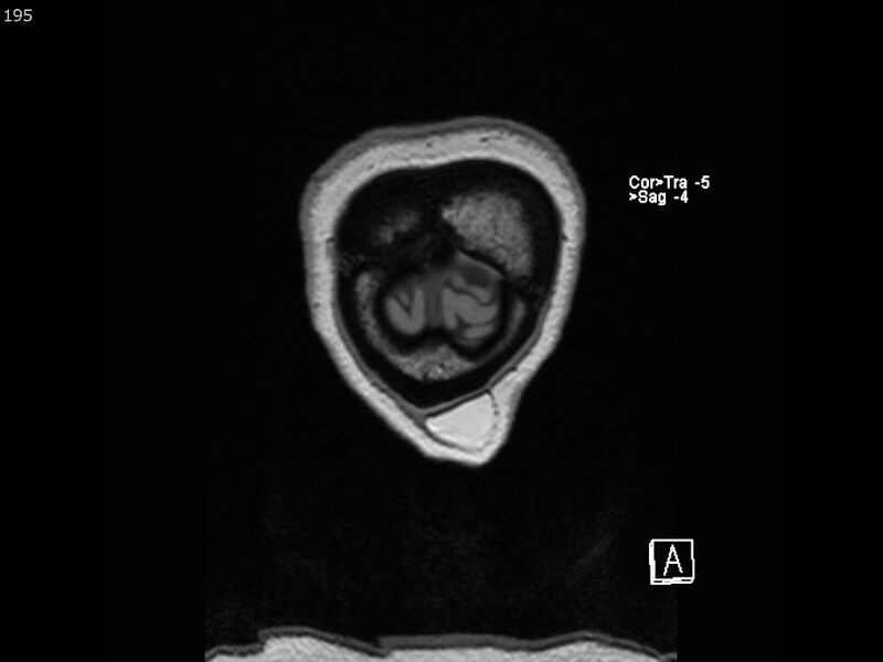 File:Atypical meningioma - intraosseous (Radiopaedia 64915-74572 Coronal T1 195).jpg