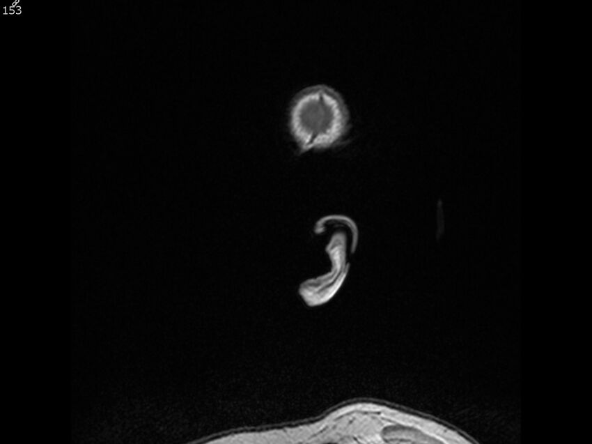 Atypical meningioma - intraosseous (Radiopaedia 64915-74572 Sagittal T1 153).jpg