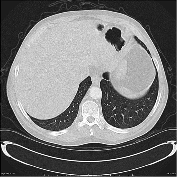 File:Atypical pneumonia - Q fever (Radiopaedia 21993-21989 lung window 43).jpg