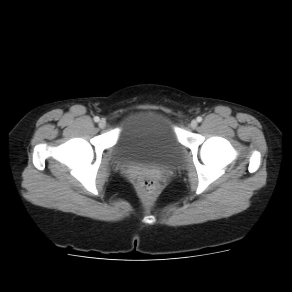 File:Autosomal dominant polycystic kidney disease (Radiopaedia 23061-23093 C 70).jpg