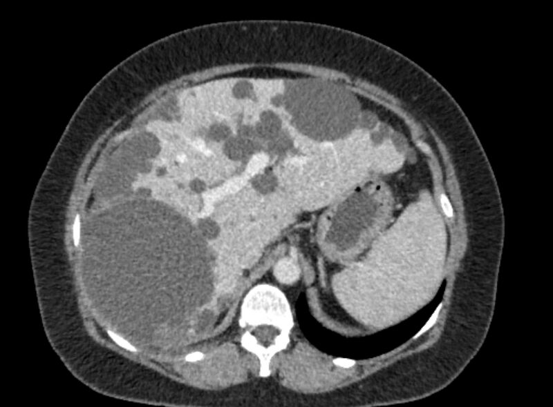 File:Autosomal dominant polycystic kidney disease (Radiopaedia 57124-64017 A 34).jpg