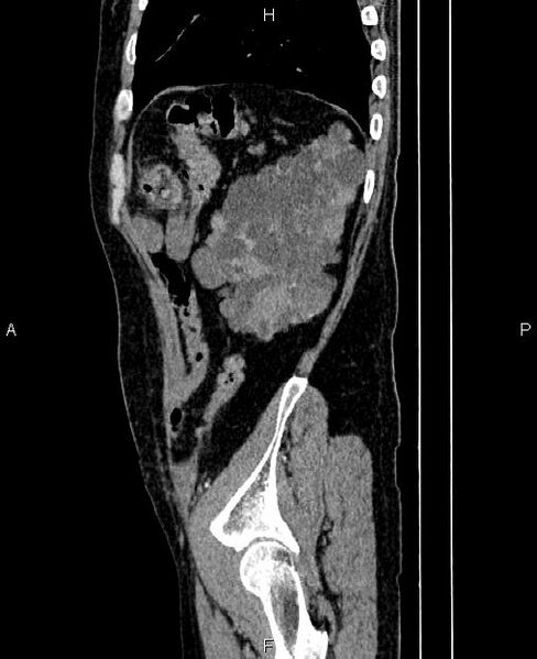 File:Autosomal dominant polycystic kidney disease (Radiopaedia 87830-104287 C 77).jpg