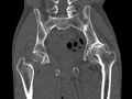Avascular necrosis of the left hip (Radiopaedia 75068-86125 Coronal bone window 45).jpg