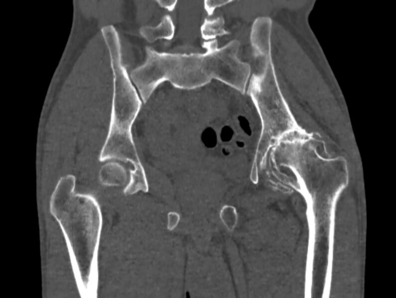 File:Avascular necrosis of the left hip (Radiopaedia 75068-86125 Coronal bone window 45).jpg