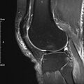 Avulsion fracture of the fibular head (Radiopaedia 74804-85808 Sagittal PD fat sat 25).jpg