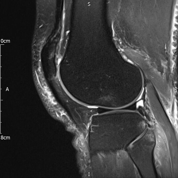 File:Avulsion fracture of the fibular head (Radiopaedia 74804-85808 Sagittal PD fat sat 25).jpg