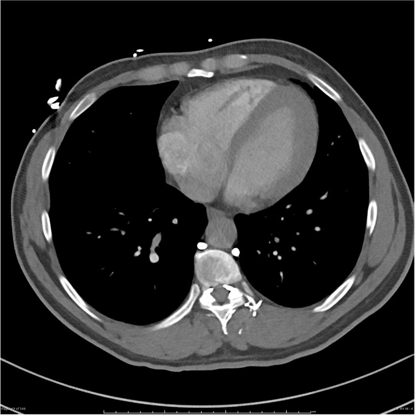 Azygos venous system anatomy (CT pulmonary angiography) (Radiopaedia 25928-26077 Axial C+ CTPA 63).jpg