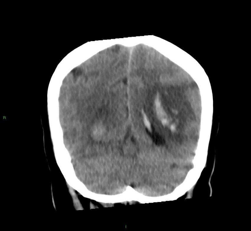 Basal ganglia hemorrhage (Radiopaedia 58759-65981 Coronal non-contrast 24).jpg