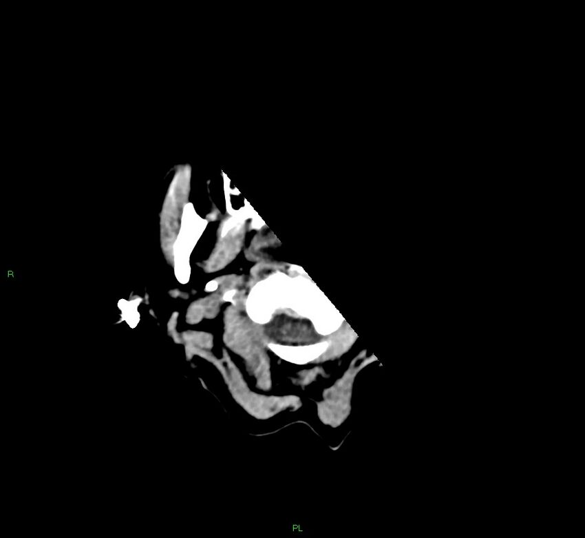 Basal ganglia hemorrhage (Radiopaedia 58766-65988 Axial non-contrast 57).jpg