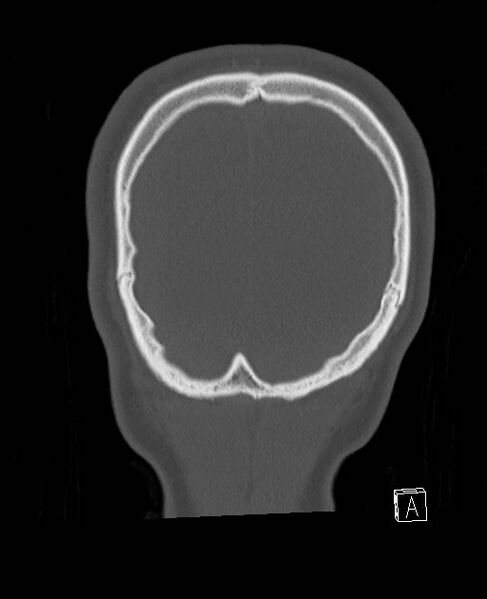 File:Base of skull fracture with bilateral Le Fort fractures (Radiopaedia 47094-51638 Coronal bone window 12).jpg