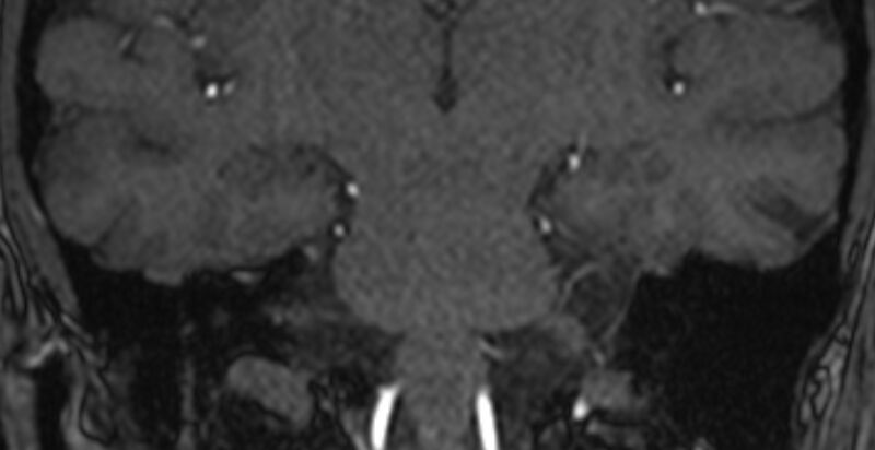 File:Basilar artery fenestration (Radiopaedia 74537-85455 Coronal MRA TOF 76).jpg