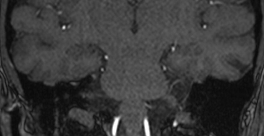 Basilar artery fenestration (Radiopaedia 74537-85455 Coronal MRA TOF 76).jpg