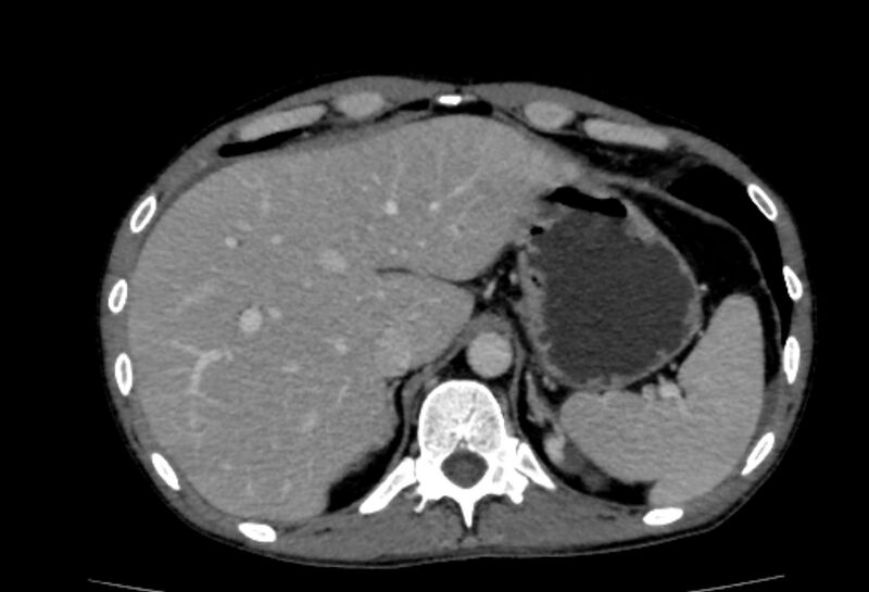 File:Behçet's disease- abdominal vasculitis (Radiopaedia 55955-62570 A 11).jpg