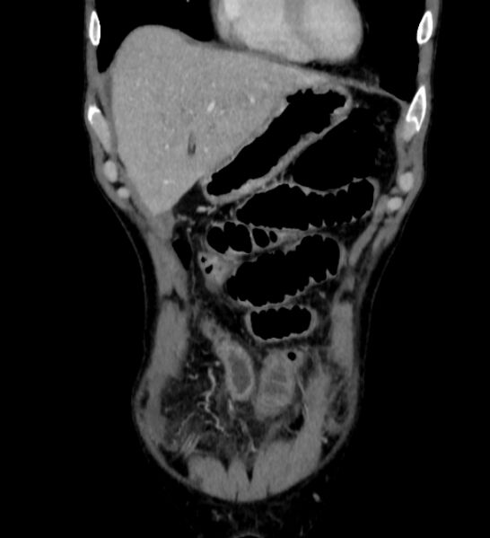 File:Behçet's disease. abdominal vasculitis (Radiopaedia 55955-62570 Coronal 46).jpg