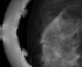Benign breast clustered microcalcifications (Radiopaedia 84548-99948 B 1).png