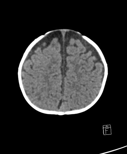 File:Benign enlargement of subarachnoid spaces in infancy (BESS) (Radiopaedia 87459-103795 Axial non-contrast 20).jpg