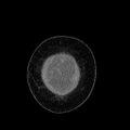 Benign leiomyoma with hydropic features (Radiopaedia 89250-106130 B 7).jpg