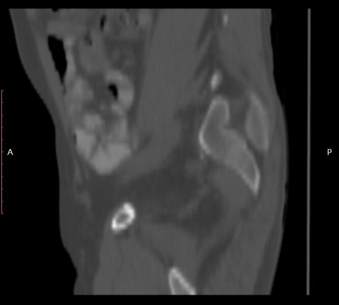 File:Bertolotti syndrome (Radiopaedia 58974-66235 Sagittal bone window 2).jpg
