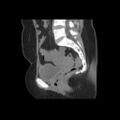 Bicornuate uterus- on MRI (Radiopaedia 49206-54296 A 10).jpg