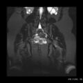 Bicornuate uterus- on MRI (Radiopaedia 49206-54297 Coronal STIR 14).jpg