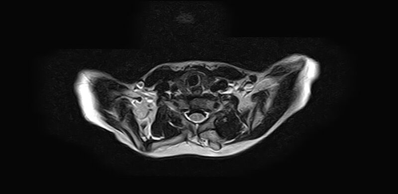 File:Bilateral Sprengel deformity with Klippel-Feil syndrome (Radiopaedia 66395-75650 Axial T2 16).jpg