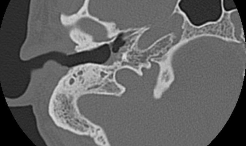 File:Bilateral cholesteatoma (Radiopaedia 54898-61172 Axial bone window 11).jpg